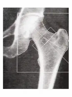 DEXA - Osteoporosis