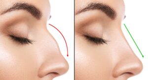 Diferencias entre rinoplastia y rinomodelación